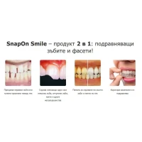 Комплект Горна и Долна ИНОВАТИВНА ПРОТЕЗА Snaponsmile