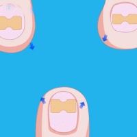 Лепенка за врастнал нокът ingrown toenail комплект от 50 броя