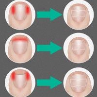 Лепенка за врастнал нокът ingrown toenail комплект от 50 броя