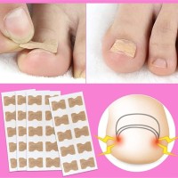 Лепенка за врастнал нокът ingrown toenail комплект от 50 броя